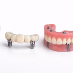 Implant Restorations