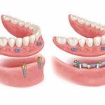 Removable implant denture